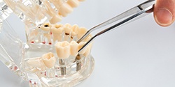 Dentist placing bridge on model dental implants