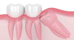 Wisdom tooth trapped under gums and pushing into other teeth