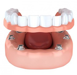 A diagram of an All-on-4 denture.