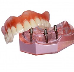 A model of an All-on-4 implant-retained denture.