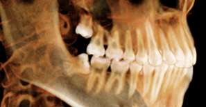 X ray of impacted wisdom teeth