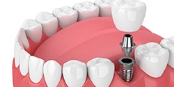 Diagram of single tooth dental implant