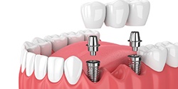 Diagram of implant bridge replacing multiple missing teeth