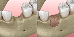 Diagram of bone grafting for dental implants