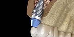 Diagram of dental implant after sinus lift