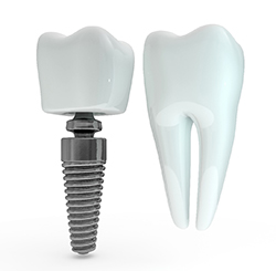Model dental implant next to model tooth for comparison