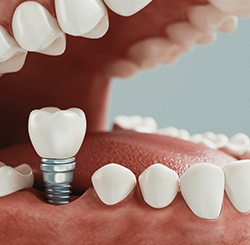 Diagram showing how dental implants are placed