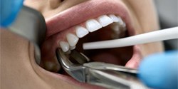 Close-up of dentist performing tooth extraction in Cambridge, OH