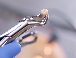 Dentist with gloves holding forceps gripping extracted tooth