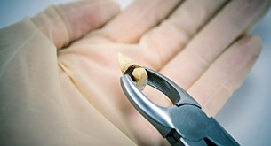 Hand and forceps holding formerly impacted wisdom tooth in Marietta, OH