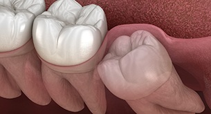 3D Illustration of impacted wisdom tooth underneath gum tissue