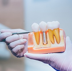 a dentist holding a model of a dental implants