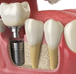 a digital illustration of a dental implant