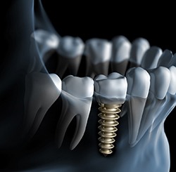 Illustration of dental implant in Marietta, OH in jaw