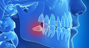 X-ray showing impacted wisdom tooth in lower jaw