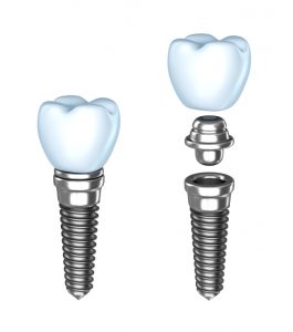 Your dental implant specialist in 43725 explains the procedure.