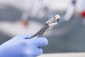 For tooth extraction in Marietta, come to Muskingum Valley Oral Surgery