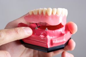 Dental implants in Cambridge can replace all your missing teeth.