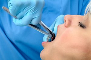 patient receiving tooth extraction