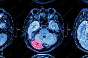 Blue brain X-ray on black background