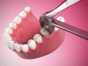 3d rendered illustration of a tooth extraction