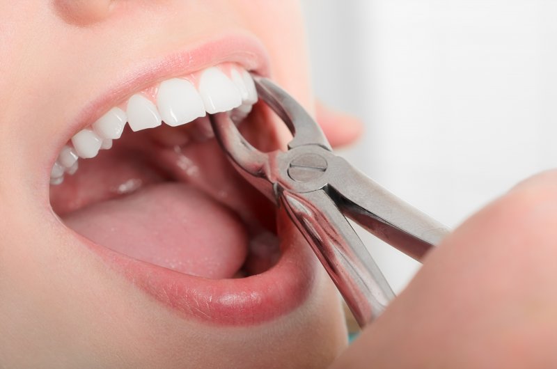 Dental forceps removing a tooth from a girl’s mouth