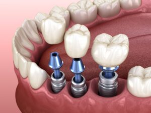 Illustration showing 3 dental implants in a lower arch
